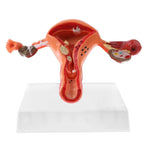 Human Pathological Uterus